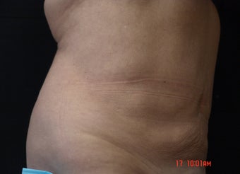 Coolsculpting after 542631