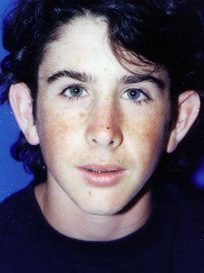 Otoplasty Male - Boy treated by Ear Surgery before 818038