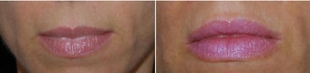 Before and After Restylane Lips before 1031286