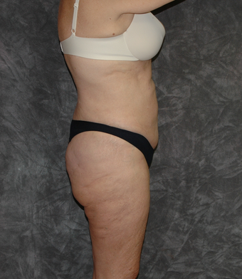 Vaser Liposuction after 925688