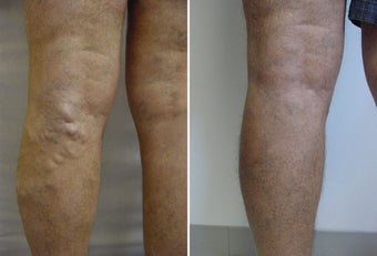 Varicose vein endovenous laser treatment before 109817