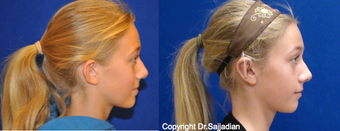 Ear Surgery before 1245299