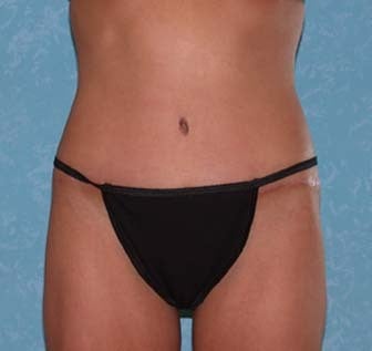 Circumferential Body Lift with Buttock Augmentation after 857126
