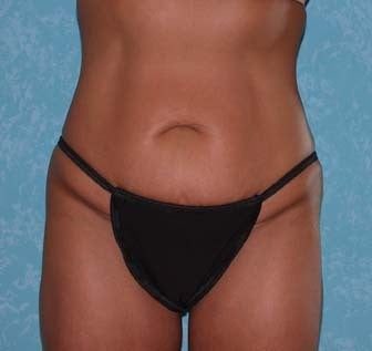 Circumferential Body Lift with Buttock Augmentation before 857126