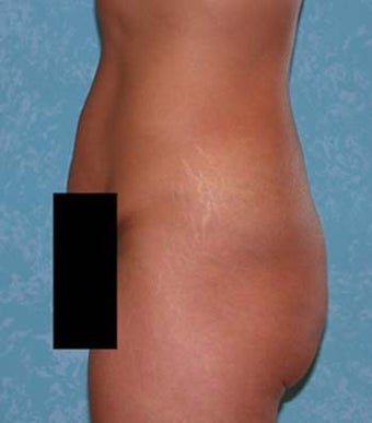 Circumferential Body Lift with Buttock Augmentation 857126