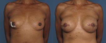 Breast & Nipple Reconstruction before 1041550