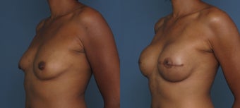 Breast & Nipple Reconstruction 1041550