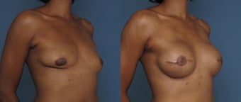 Breast & Nipple Reconstruction after 1041550