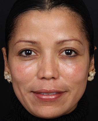 Cosmelan for Melasma after 539871