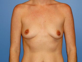 Breast augmentation with saline implants before 78757