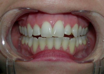 Dental veneer to correct small misaligned front teeth before 700796
