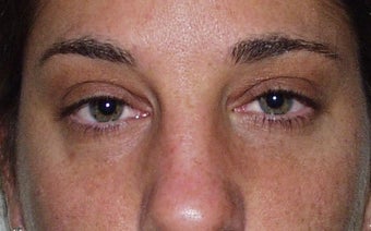Blepharoplasty after 228412