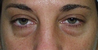 Blepharoplasty before 228412