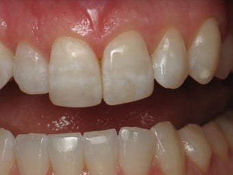 Dental Bonding after 372786