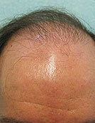 Head and Body FUE SFET Repair before 195649