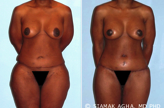 Body Lift before 216793