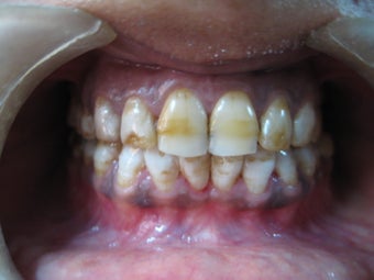 Laser Speed Tooth Whitening before 773989