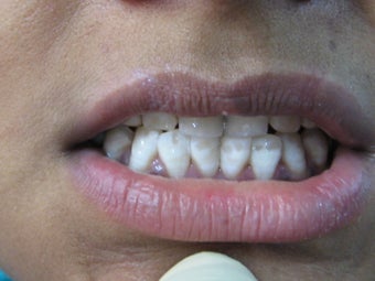 Laser Speed Tooth Whitening after 773989