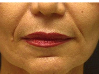 Sculptra before 184971