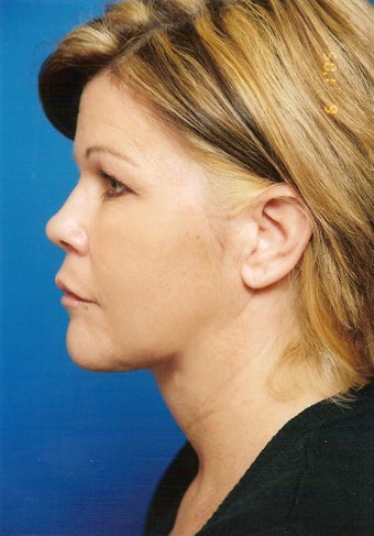 Neck Lift after 902854