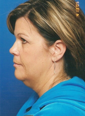 Neck Lift before 902854