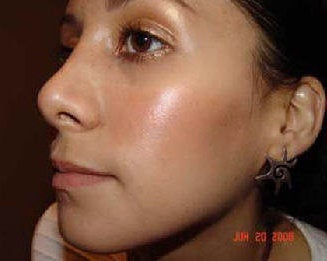 Rhinoplasty after 172964