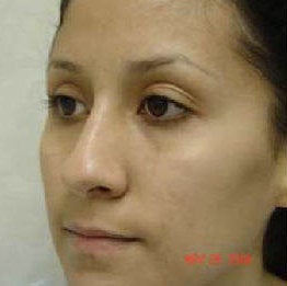 Rhinoplasty before 172964