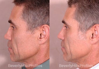 Revision Rhinoplasty before 681870