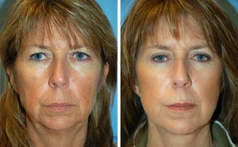 Facelift before 91466