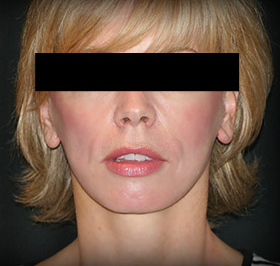 In-Office Facelift after 1108611