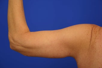 Arm lift after 461872