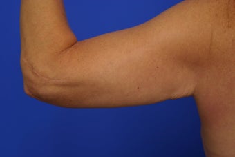 Arm lift before 461872