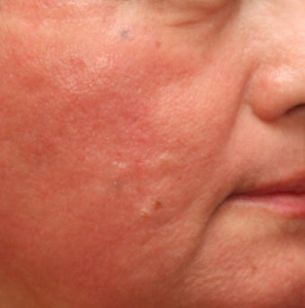 Fraxel Repair for indented Acne Scars after 110207
