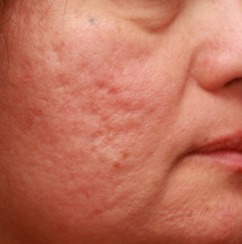 Fraxel Repair for indented Acne Scars before 110207