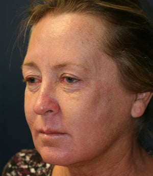 Eyelid blepharoplasties to open upper eyelids 845415
