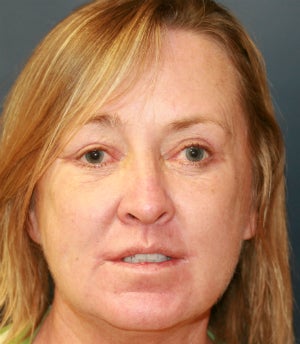 Eyelid blepharoplasties to open upper eyelids after 845415