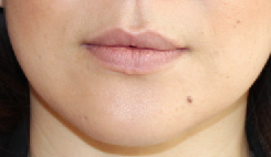 Lip Implants before 944168