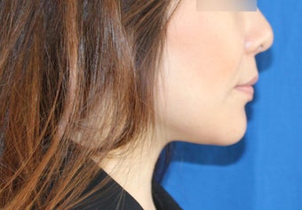 Lip Implants 944168