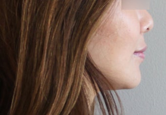 Lip Implants 944168
