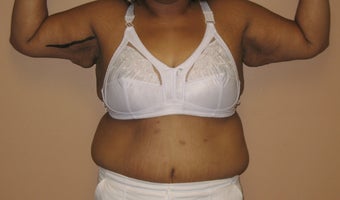 45 y/o female treated for sagging arms before 635498