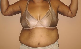 45 y/o female treated for sagging arms after 635498