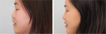 Double eyelid incisional surgery - before & 2 months post op 921753