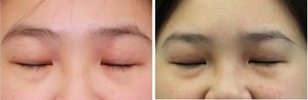 Double eyelid incisional surgery - before & 2 months post op 921753