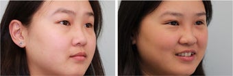Double eyelid incisional surgery - before & 2 months post op after 921753