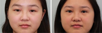 Double eyelid incisional surgery - before & 2 months post op before 921753