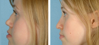 Functional Rhinoplasty before 1208312