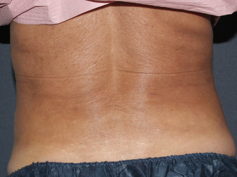 Liposculpture after 596227
