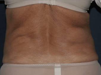 Liposculpture before 596227