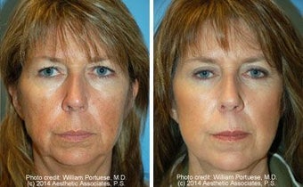 Facelift before 91466