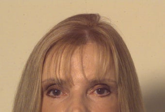 CO2 Laser Resurfacing after 112801